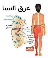 عرق النسا – وكالة عجلون الإخبارية